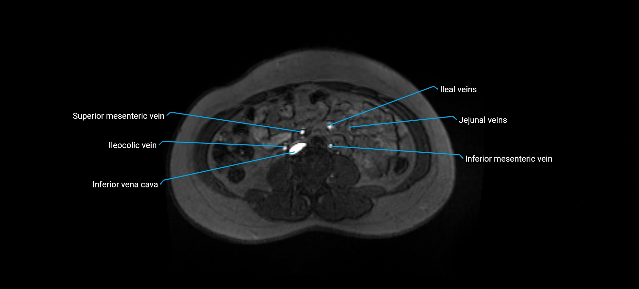 MRV abdomen pelvis & lower limb axial cross sectional anatomy labelled MRI image 100 (1).webp